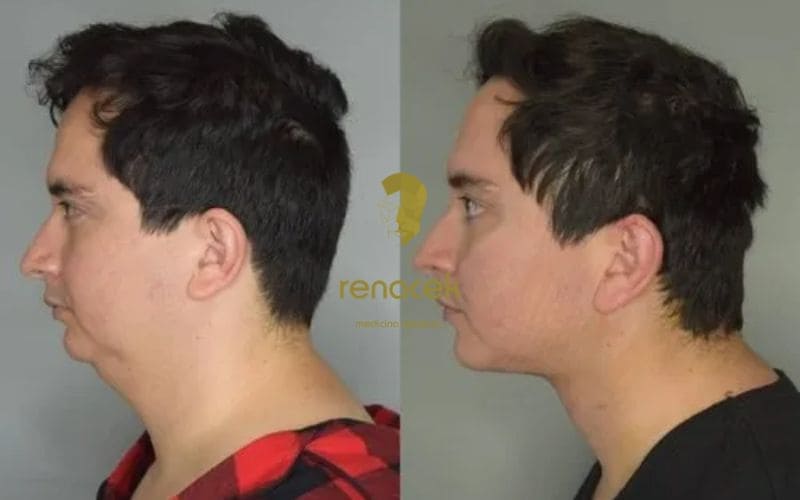 caso liposuccion de papada barcelona