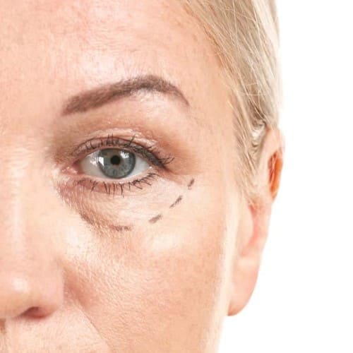 cirugia blefaroplastia barcelona