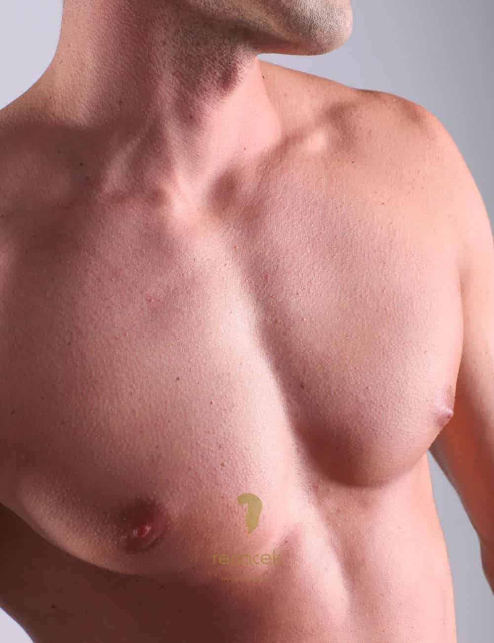 ginecomastia en barcelona