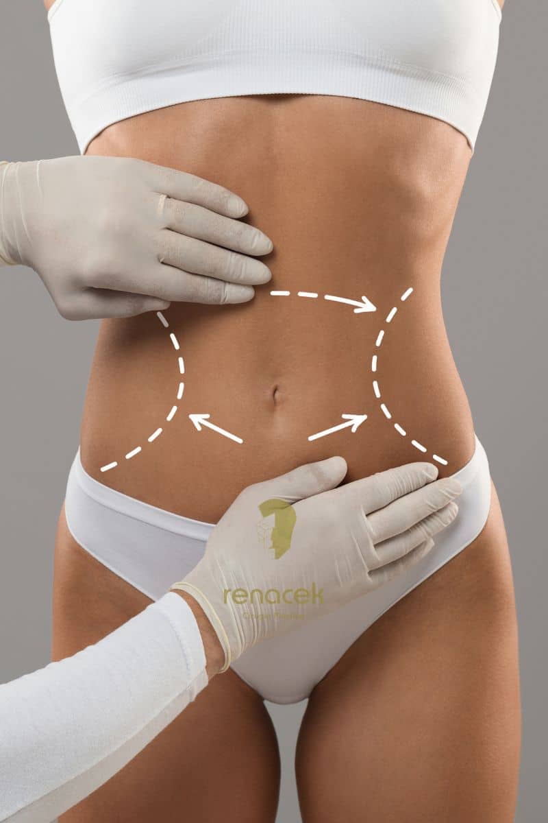 liposuccion barcelona