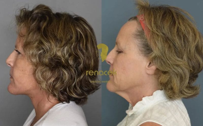 liposuccion papada antes y despues barcelona