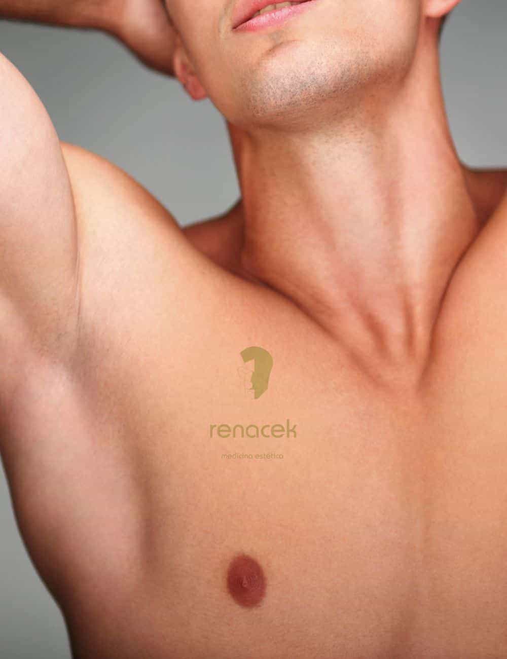 operacion ginecomastia barcelona