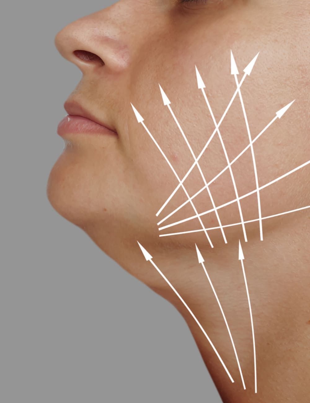 reducir papada operacion barcelona