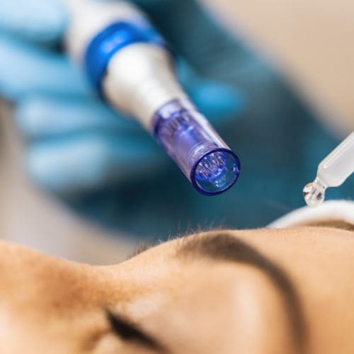 dermapen madrid