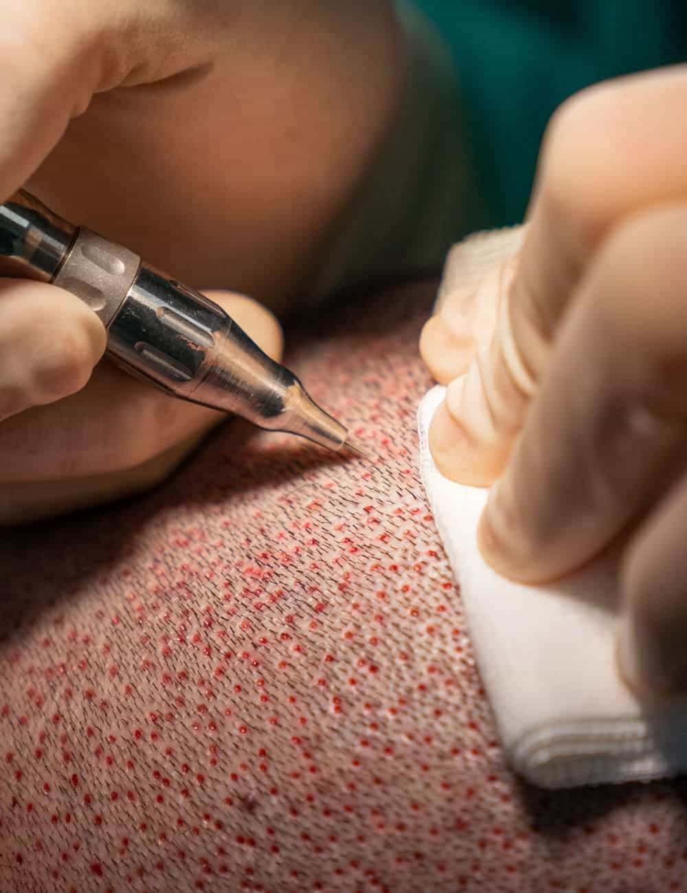 implante capilar barcelona