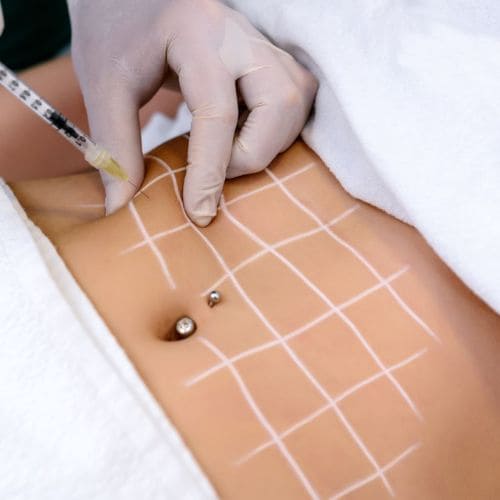 mesoterapia corporal madrid