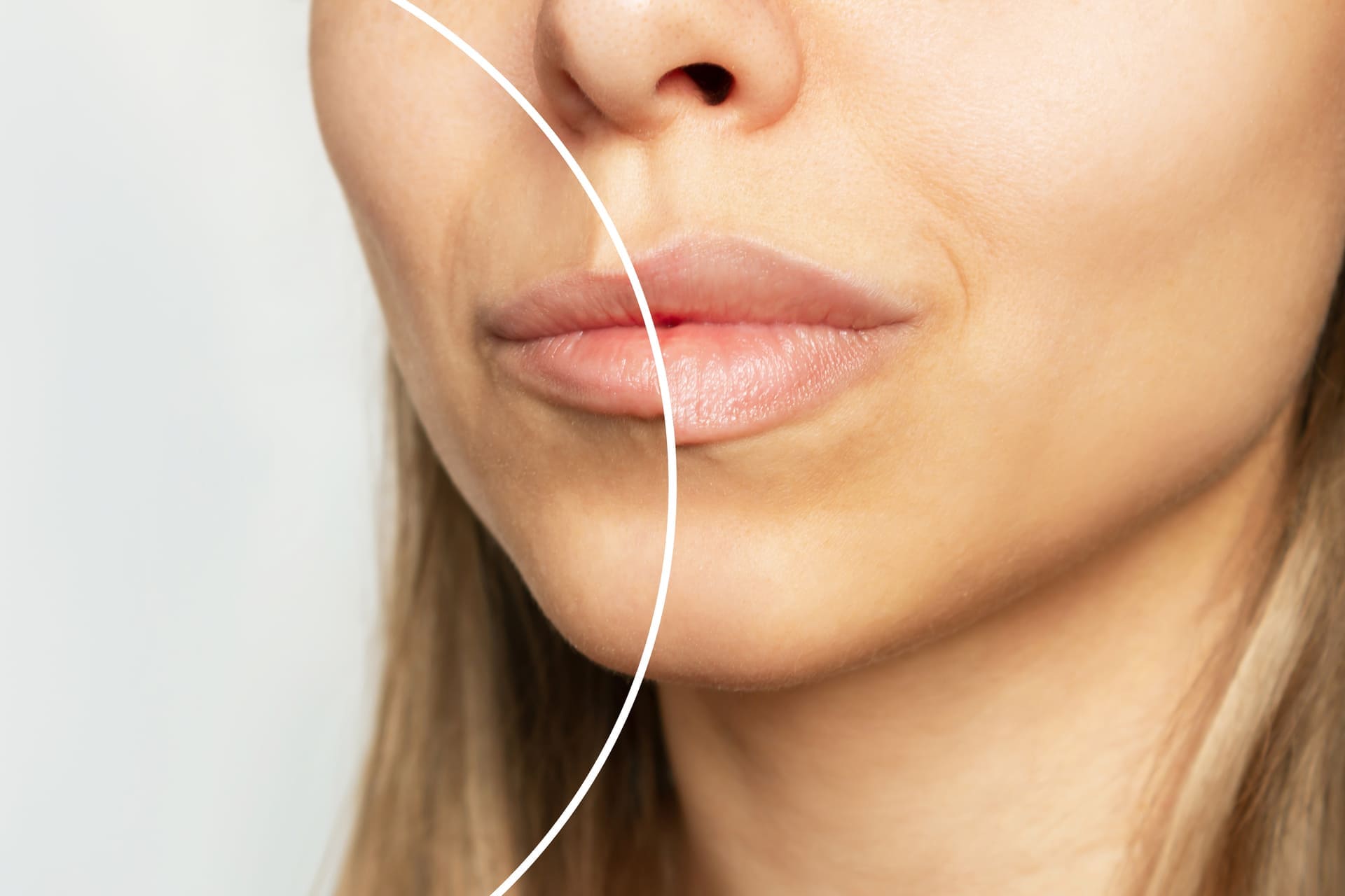 Resultado de un aumento de labios con ácido hialurónico, antes y después