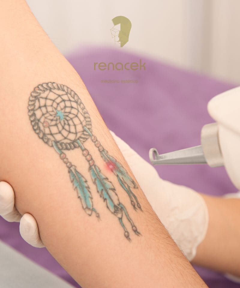 eliminar tatuajes zaragoza