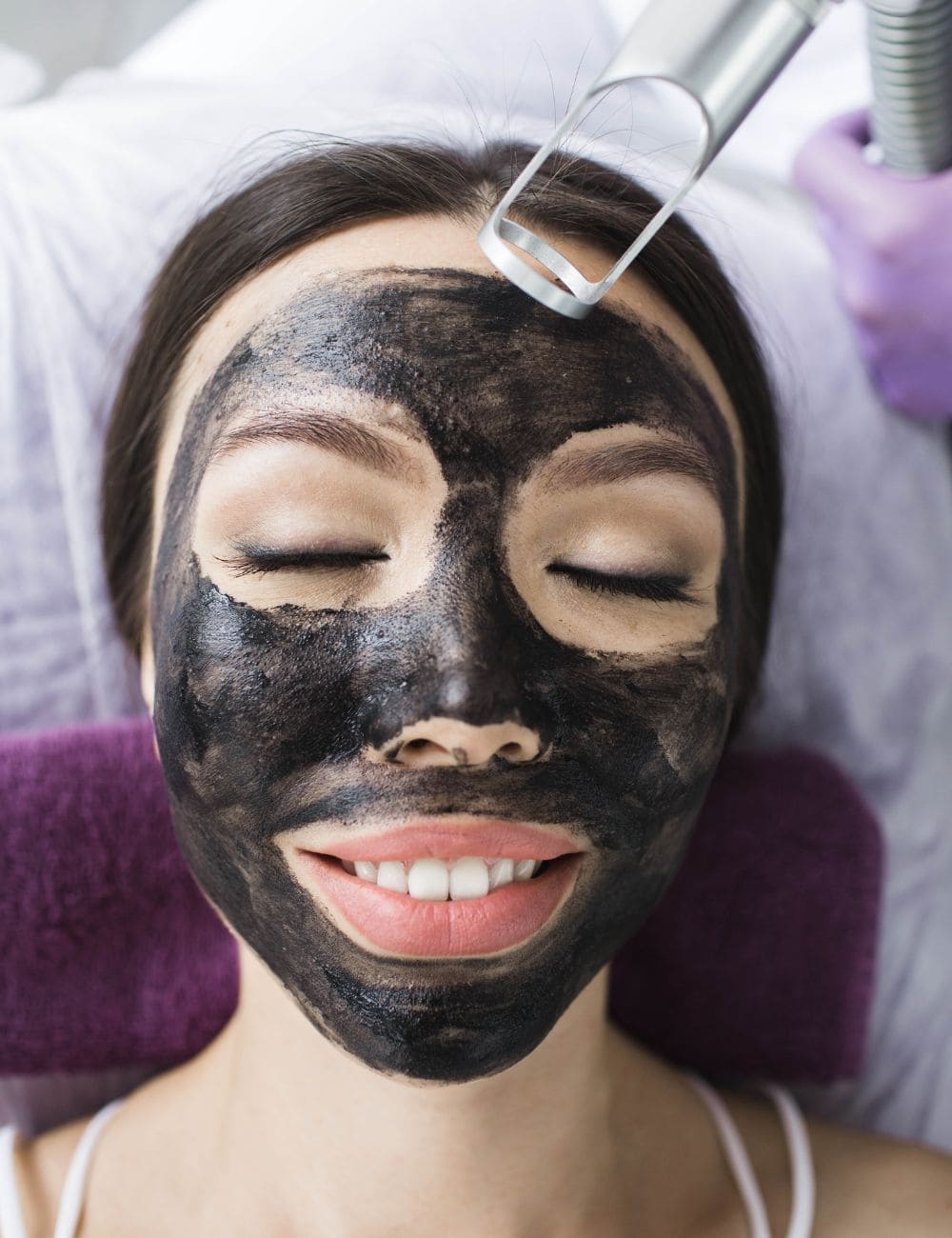 peeling carbon laser zaragoza