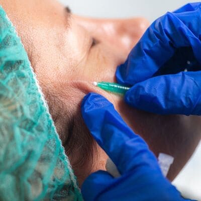 Curso de hilos tensores faciales — formación en medicina estética