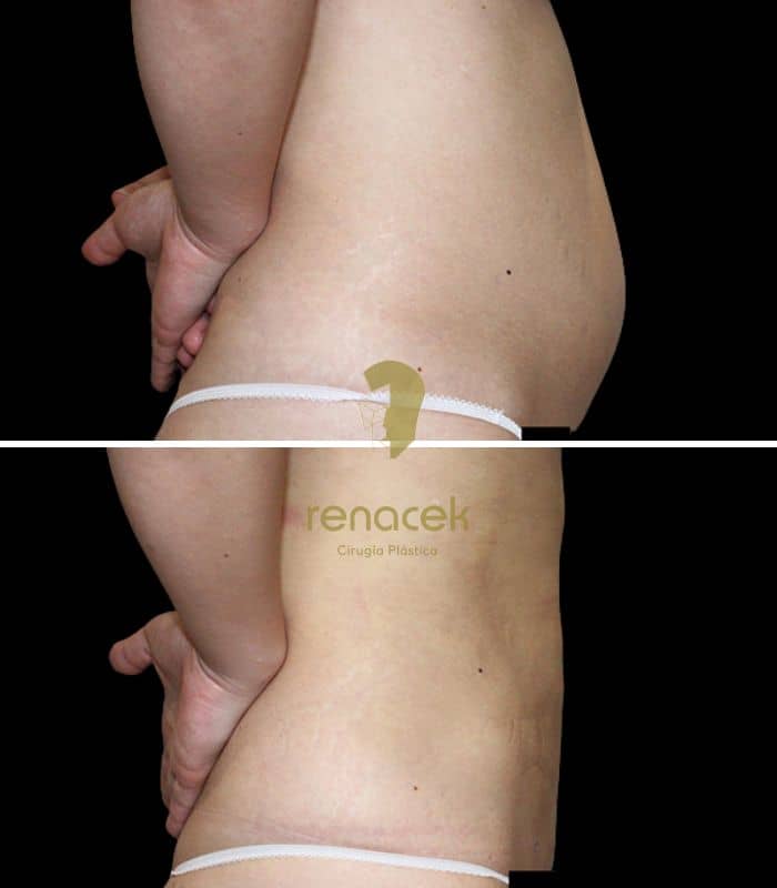 Lipoláser de abdomen en perfil: antes y después real en Renacek