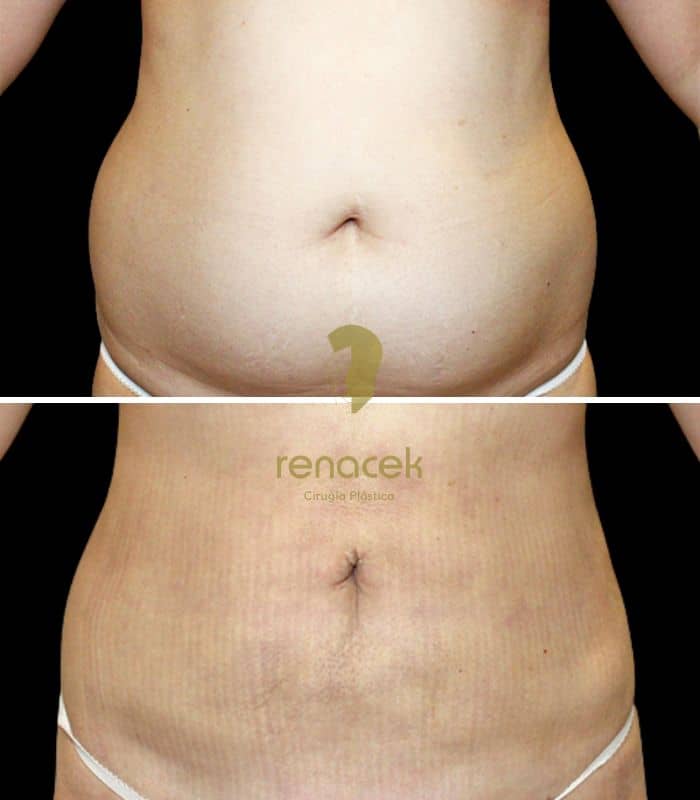 Lipoláser de abdomen: resultado real de una paciente en Renacek Zaragoza