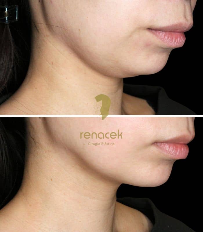 EndoLift de papada: antes y después real en Renacek Zaragoza