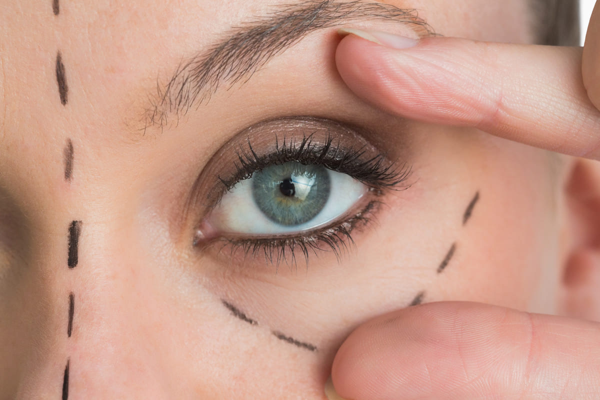 Blefaroplastia