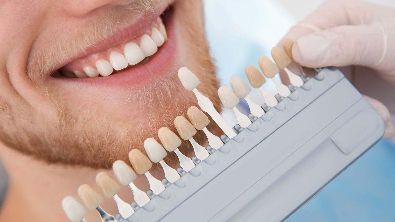 Selección del color de unas carillas dentales con la guía de tonos