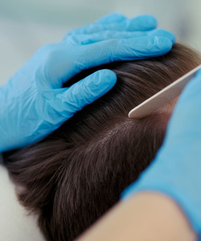 test alopecia zaragoza