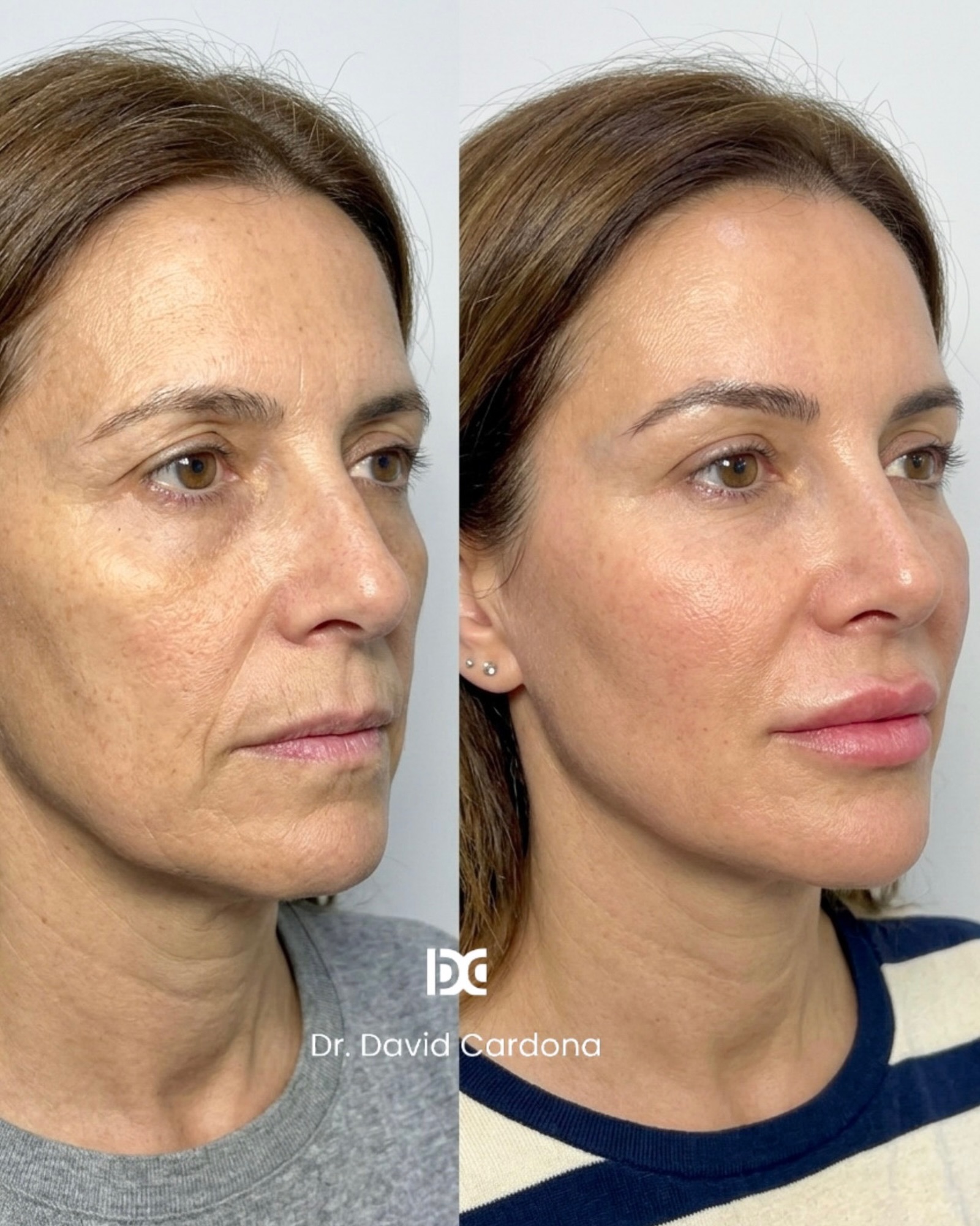 Armonización facial: antes y después real en Renacek Zaragoza