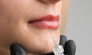 Primer plano de una infiltración de ácido hialurónico en el labio