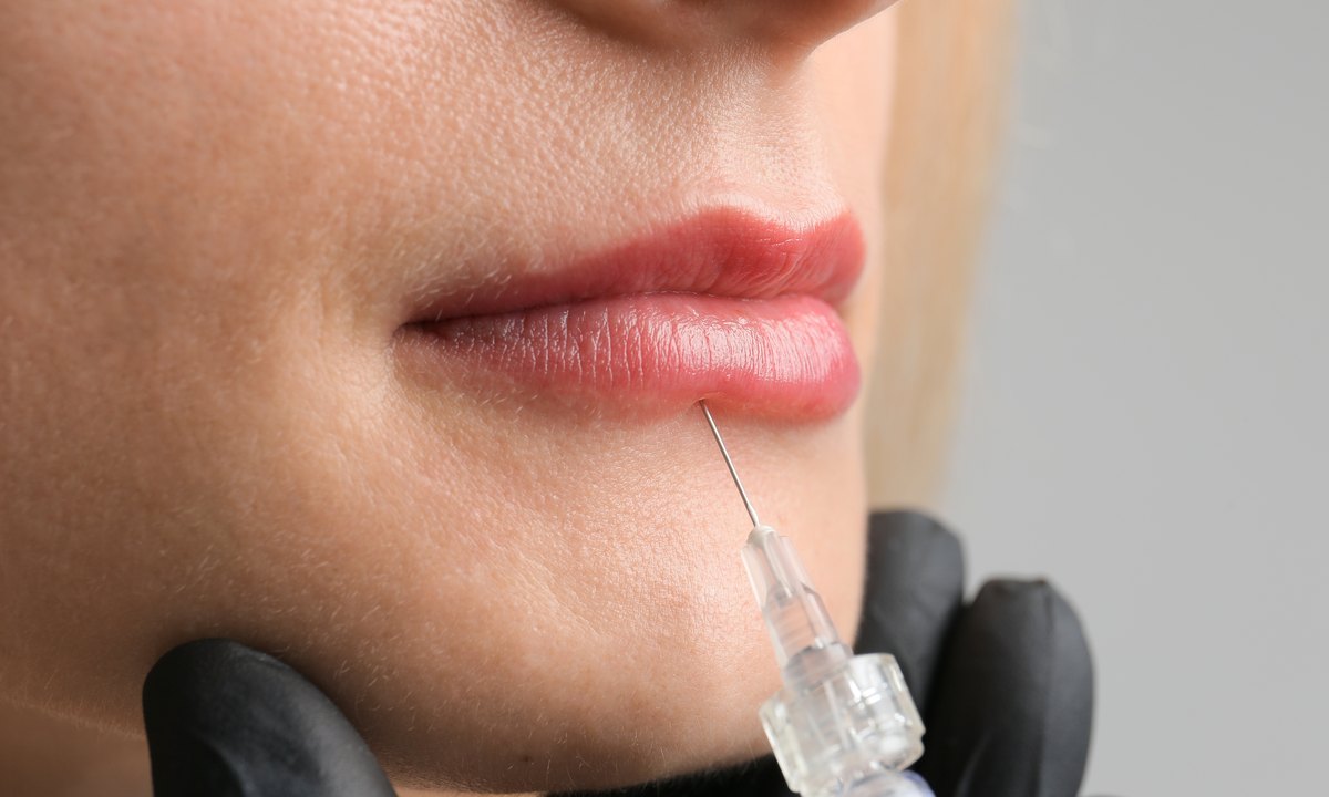 Primer plano de una infiltración de ácido hialurónico en el labio