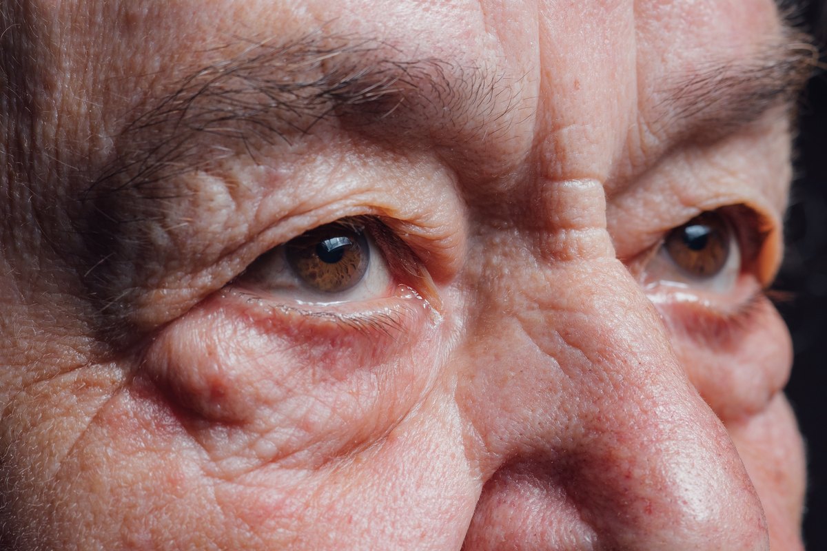 Primer plano de los ojos de un hombre mayor con bolsas marcadas bajo los párpados inferiores