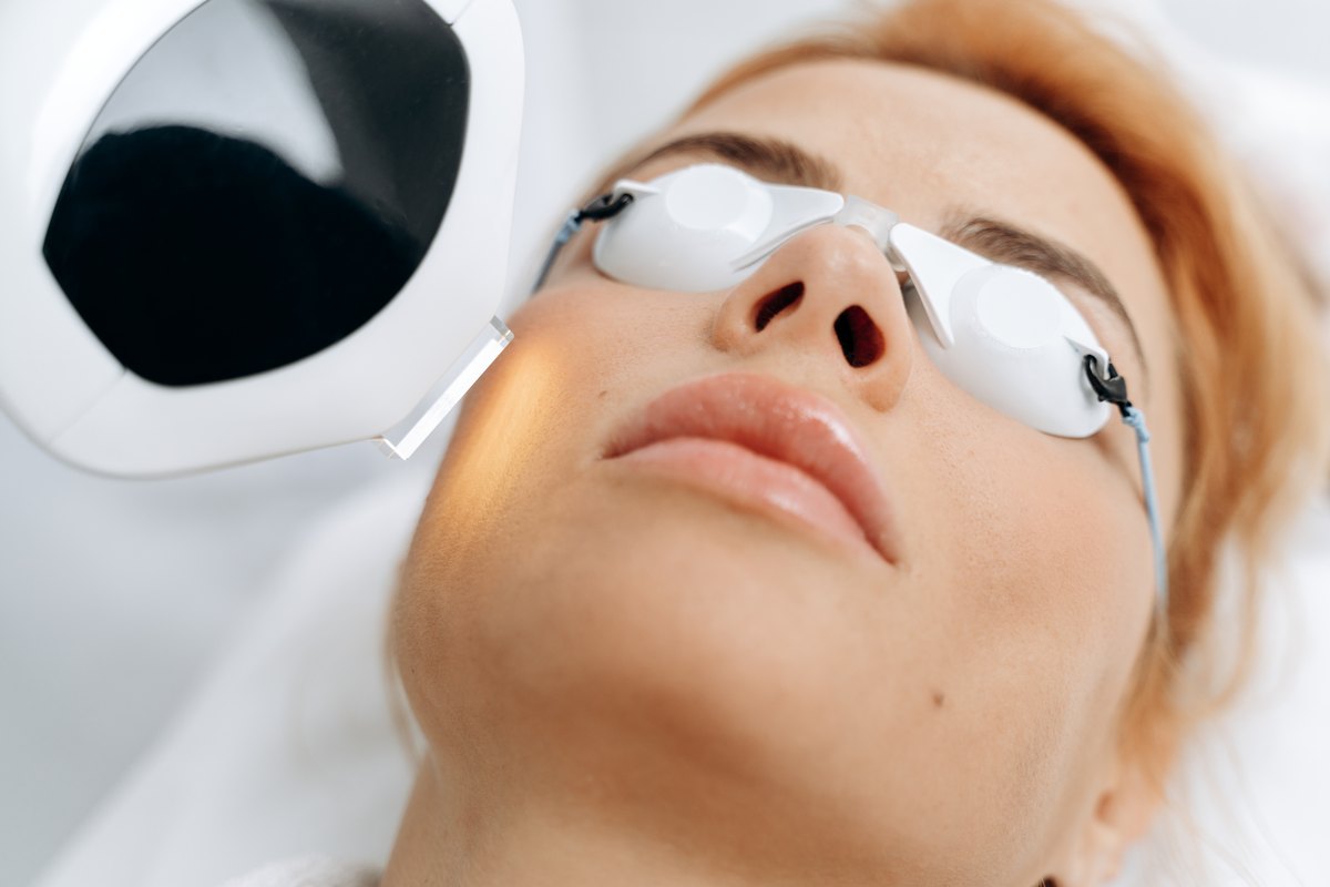 Sesión de láser en la cara de una mujer tumbada con gafas de protección, con el cabezal del equipo junto a la mejilla y el labio superior